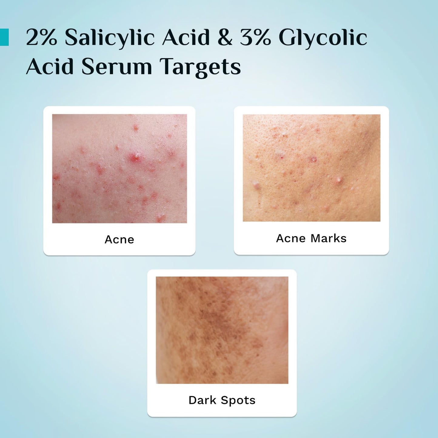 Pilgrim Salicylic Acid 2% + Glycolic Acid 3% Anti Acne Serum | Resurfaces & Retexturizes Skin| Reduces Excess Oil | Dermatologically Tested | All Skin Type | For Men & Women | Vegan 30 MILLI_LITRE