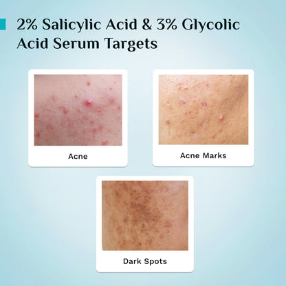 Pilgrim Salicylic Acid 2% + Glycolic Acid 3% Anti Acne Serum | Resurfaces & Retexturizes Skin| Reduces Excess Oil | Dermatologically Tested | All Skin Type | For Men & Women | Vegan 30 MILLI_LITRE