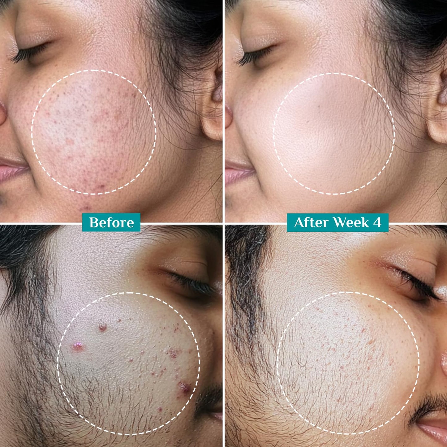 Pilgrim Salicylic Acid 2% + Glycolic Acid 3% Anti Acne Serum | Resurfaces & Retexturizes Skin| Reduces Excess Oil | Dermatologically Tested | All Skin Type | For Men & Women | Vegan 30 MILLI_LITRE