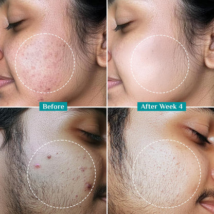 Pilgrim Salicylic Acid 2% + Glycolic Acid 3% Anti Acne Serum | Resurfaces & Retexturizes Skin| Reduces Excess Oil | Dermatologically Tested | All Skin Type | For Men & Women | Vegan 30 MILLI_LITRE